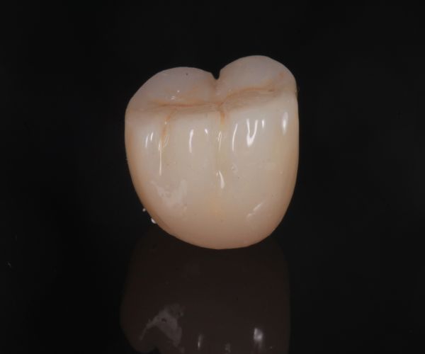 Se realiza implante dental con corona de zirconia